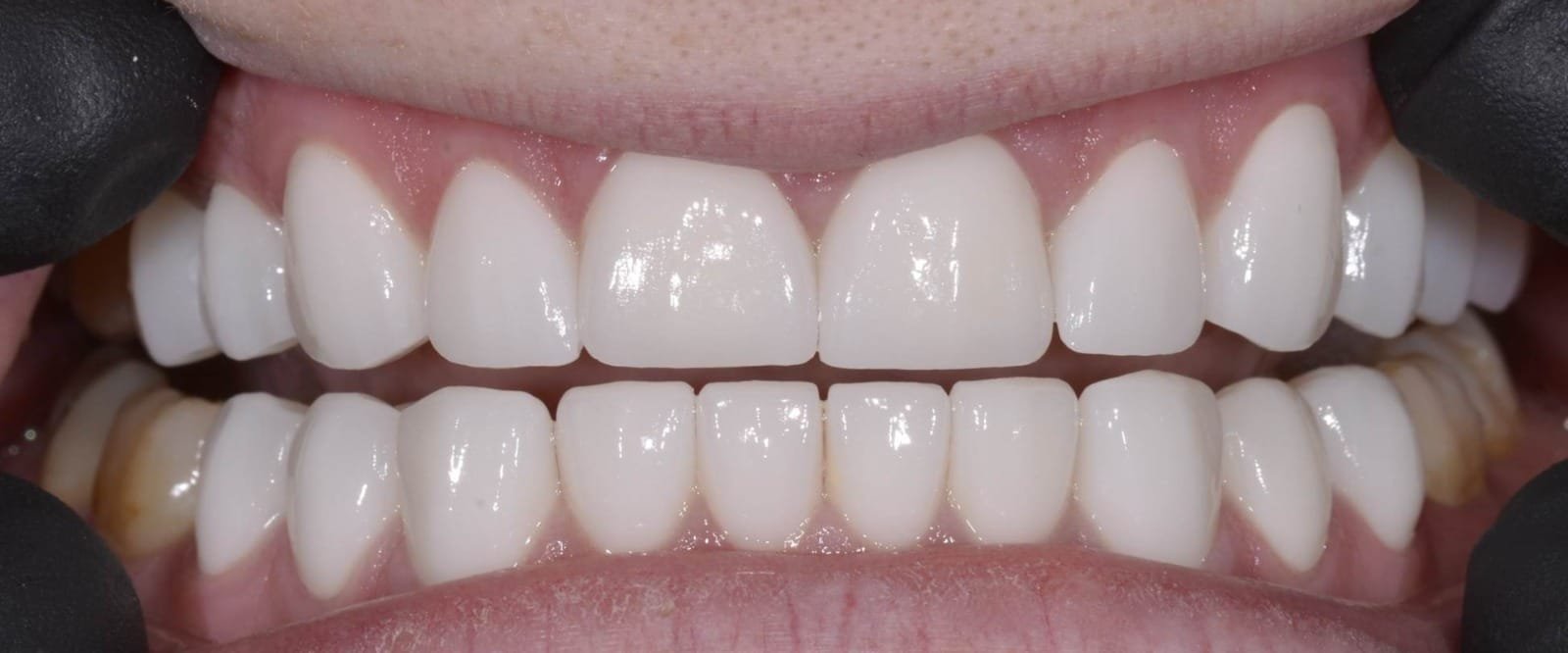 Multi-layer-Zirconia.-2.jpeg