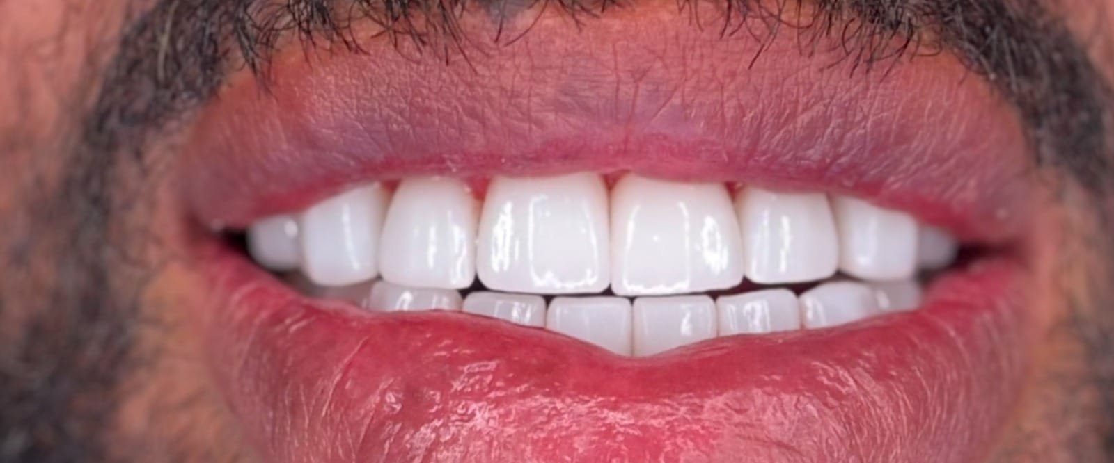Zirconia-Multi-layer-1.jpeg