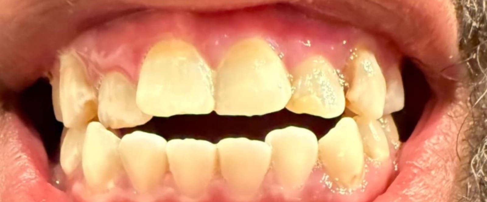 Zirconia-Multi-layer-2.jpeg Zirconia-Multi-layer-2.jpeg