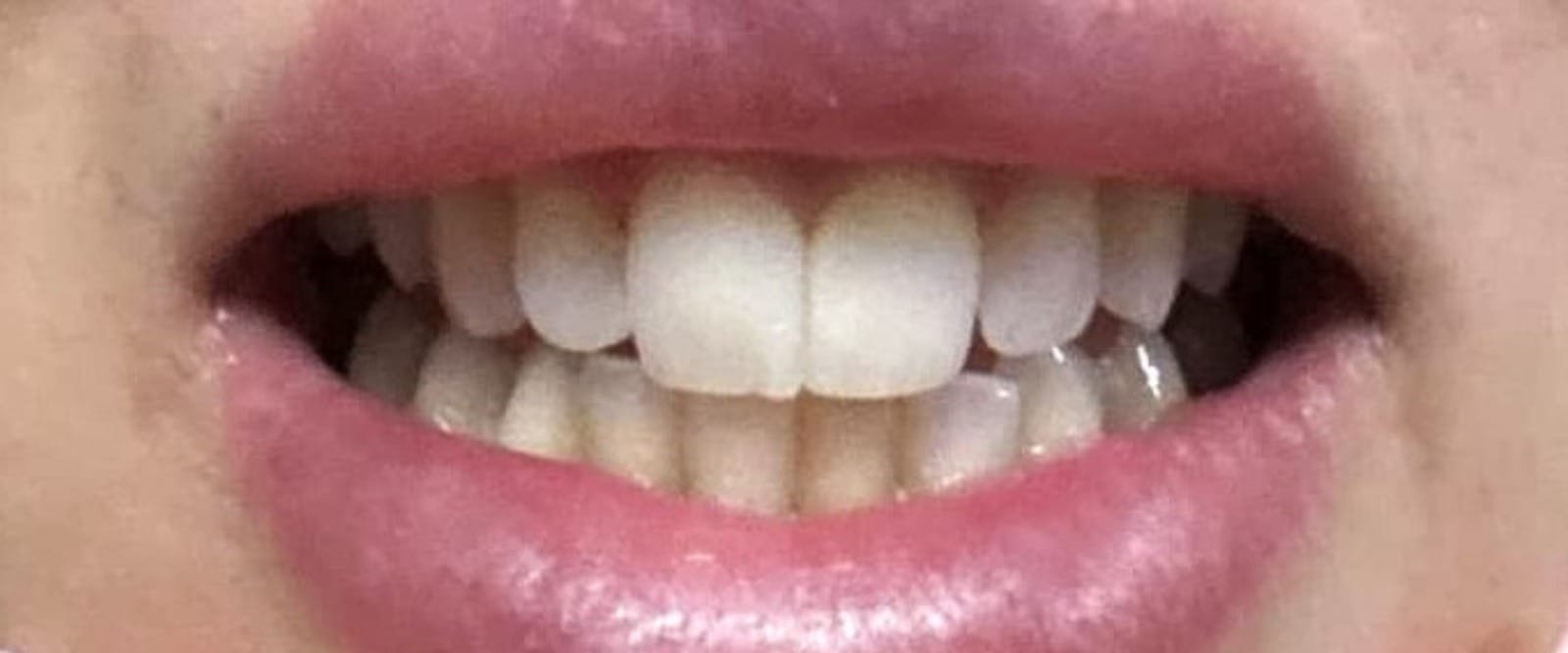 Zirconia-Multi-layer-Crowns-10.jpeg Zirconia-Multi-layer-Crowns-10.jpeg