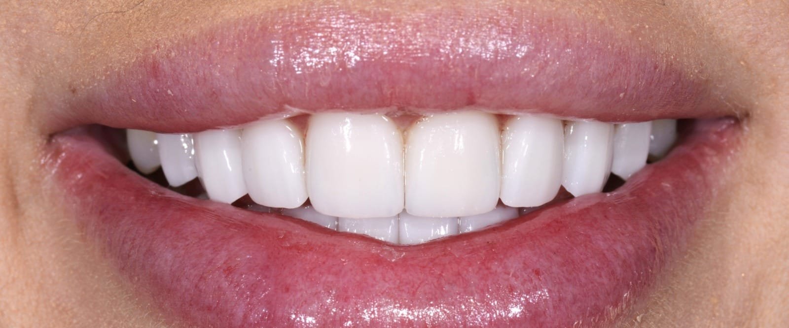 Zirconia-Multi-layer-Crowns-2.jpeg