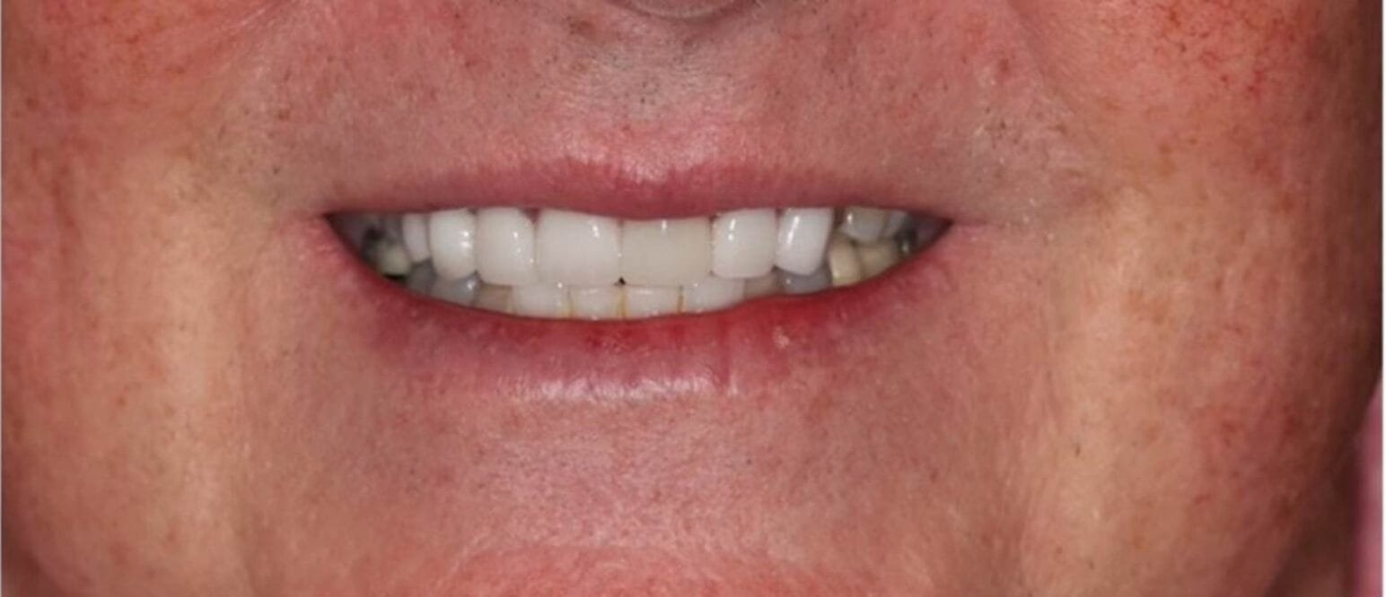 zirconia-crowns-1-e1738217268936.jpeg zirconia-crowns-1-e1738217268936.jpeg