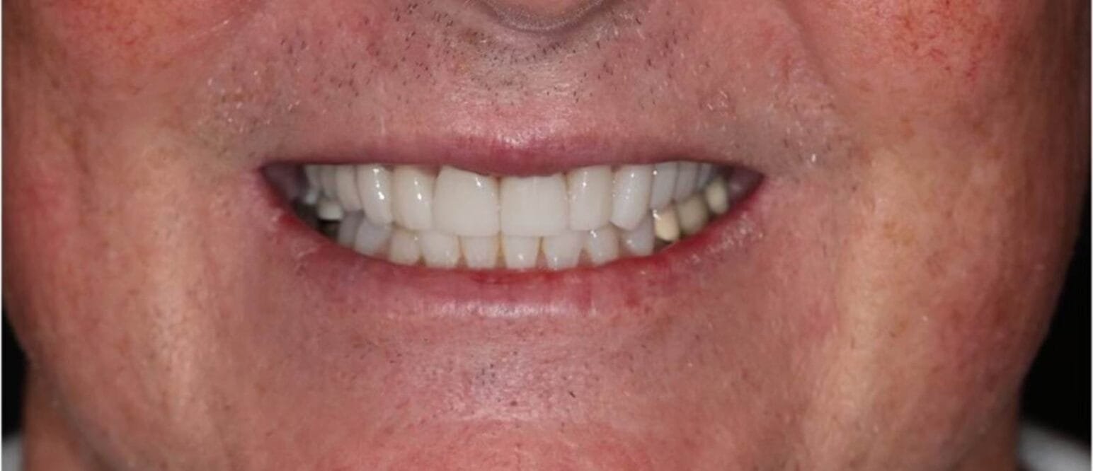zirconia-crowns-2-e1738217286137.jpeg